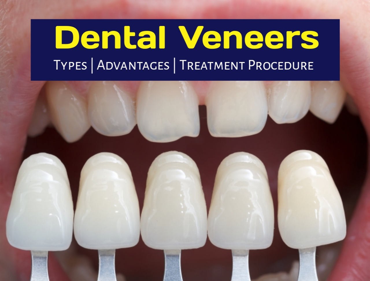 Dental Veneers Treatment in Thane