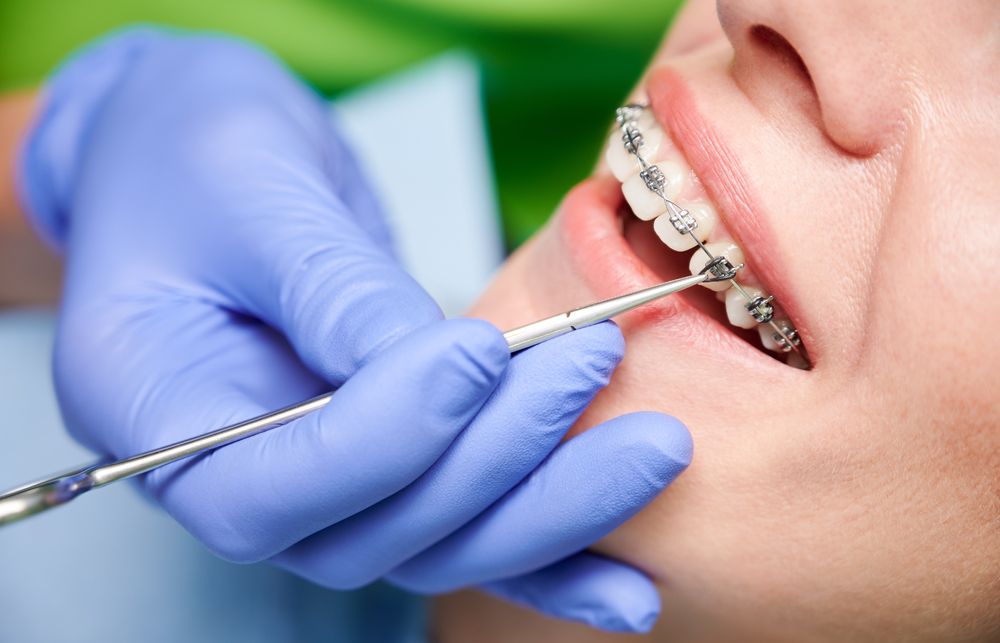 Dental braces treatment for kids in Thane