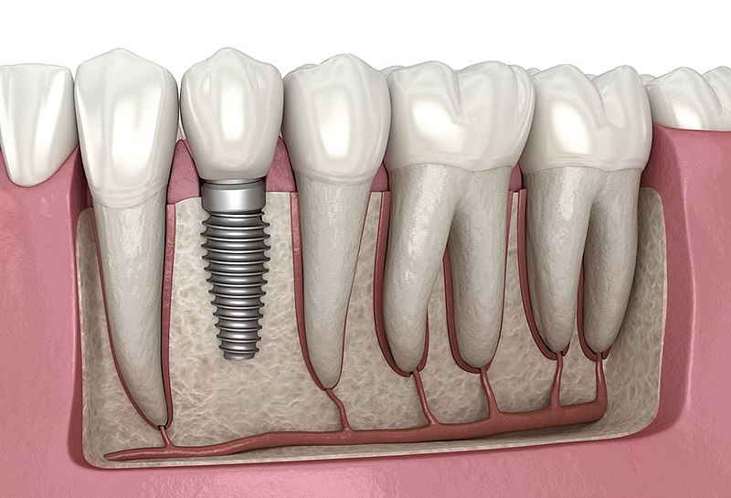 Best dental implant services near Mulund