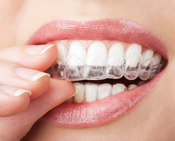 Invisalign treatment clinic in Thane