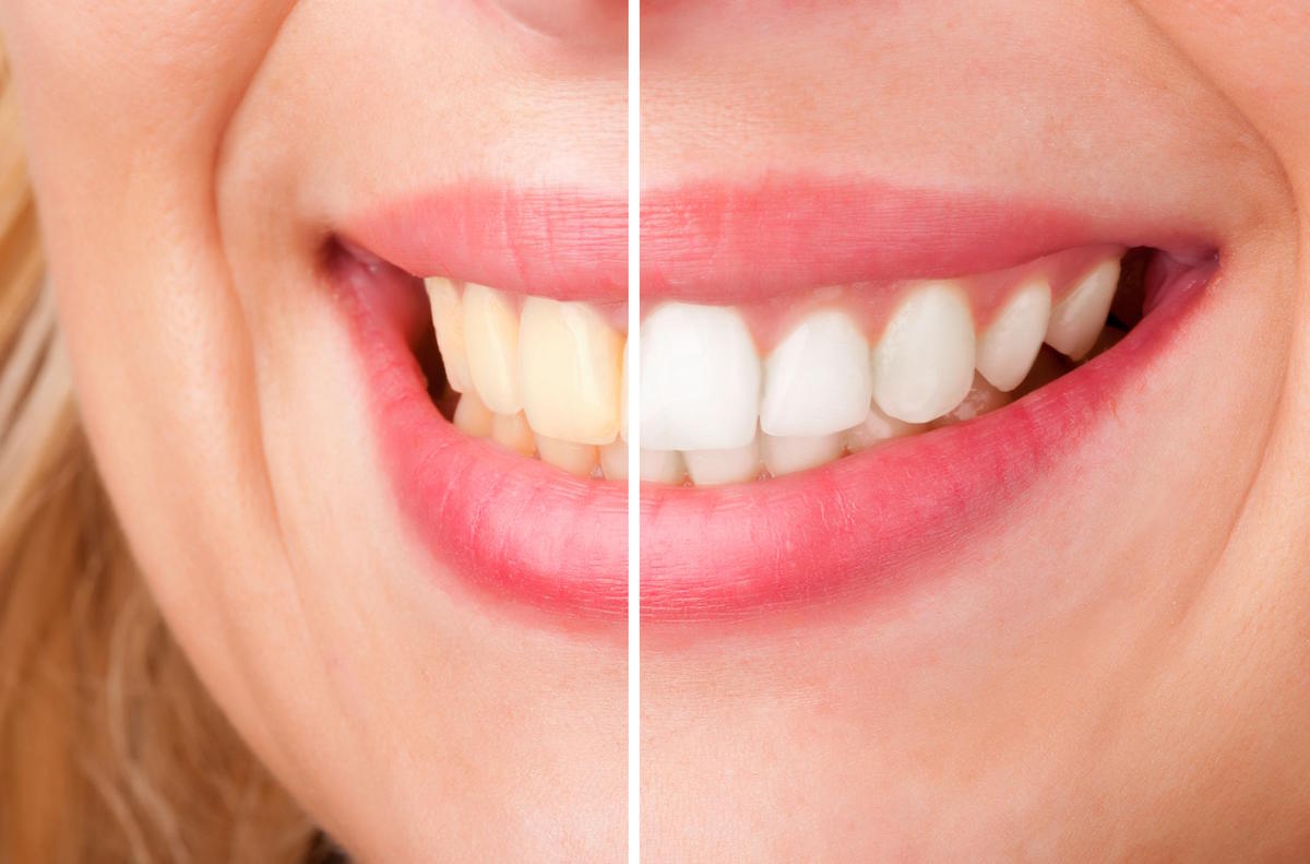 teeth whitening treatment in Thane