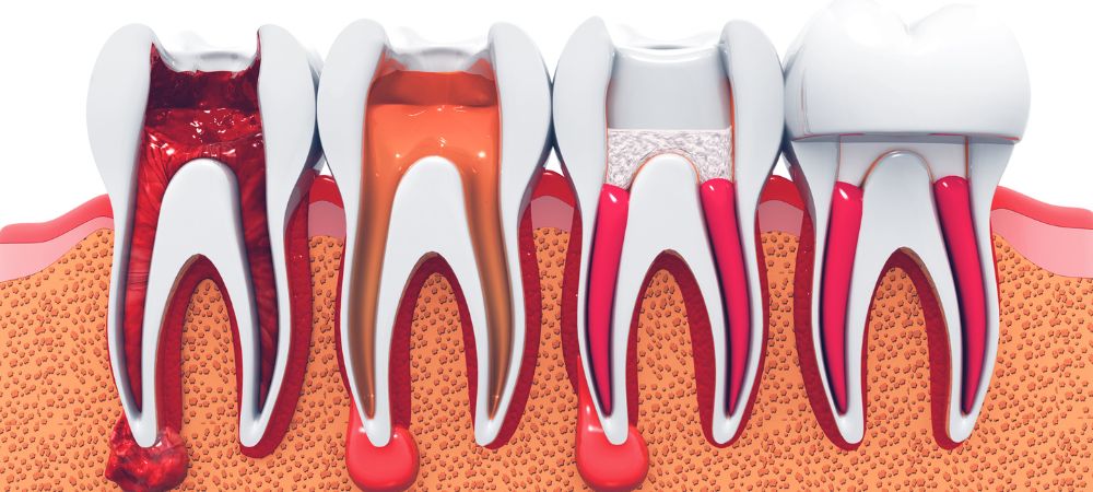 best root canal treatment in Thane