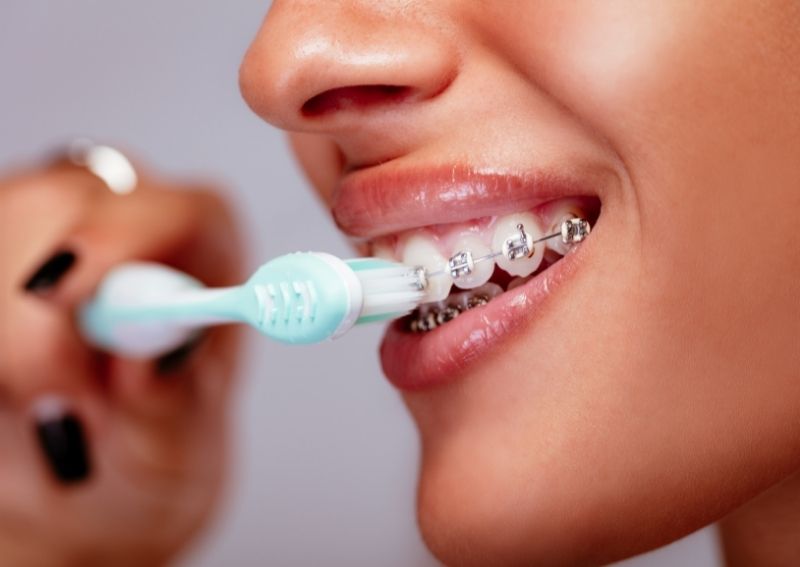 dental braces treatment in Thane