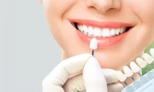 Dental Veneers in Thane