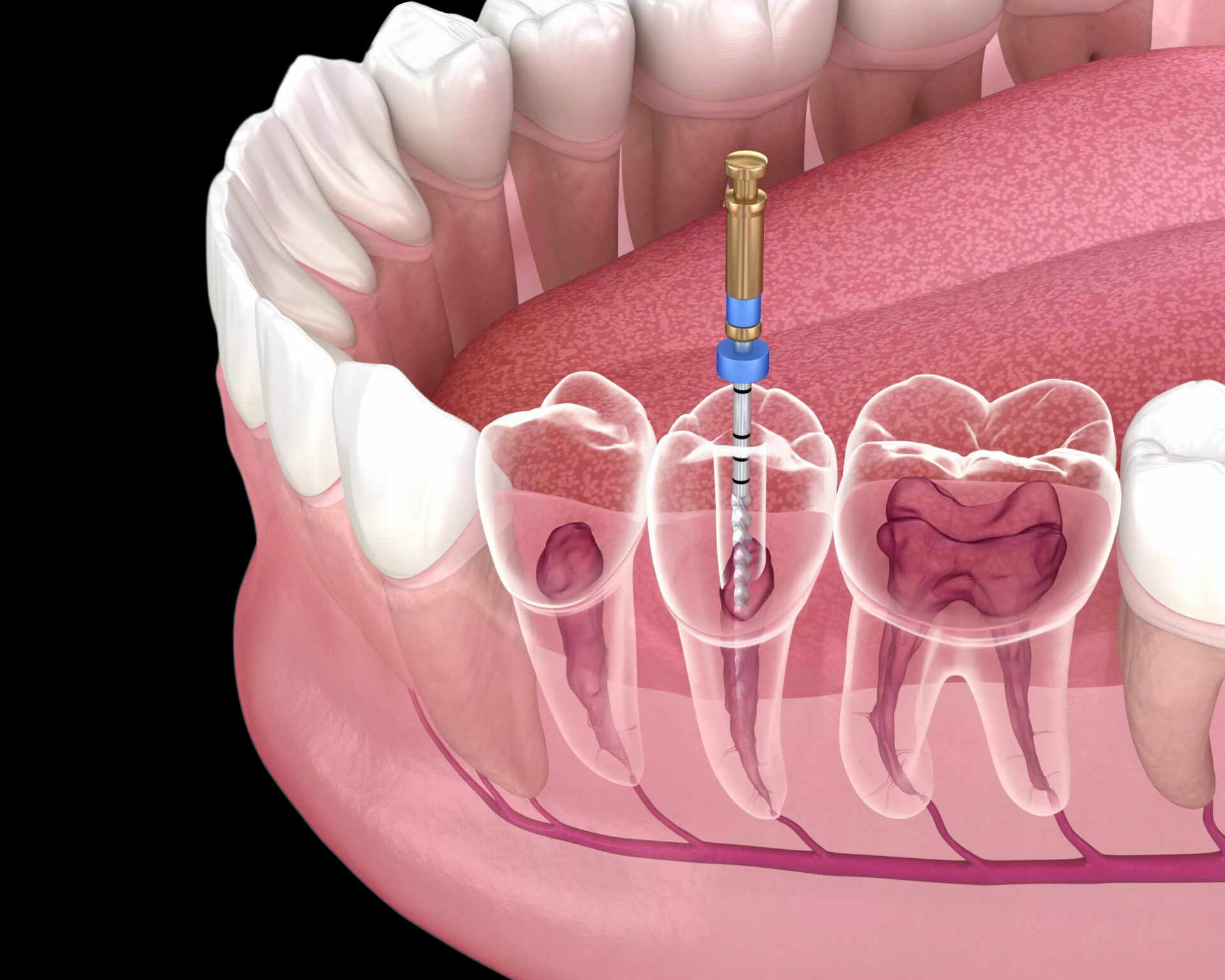 root canal treatment doctors in Thane