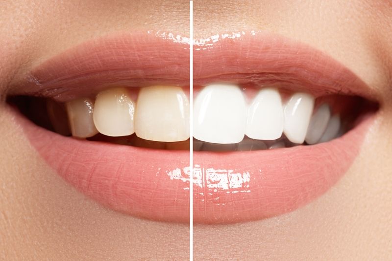 Teeth whitening treatment in Thane