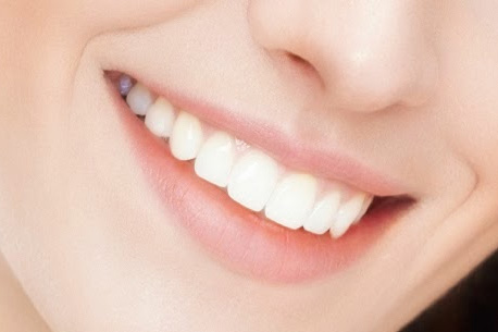 dental veneers treatment in Thane