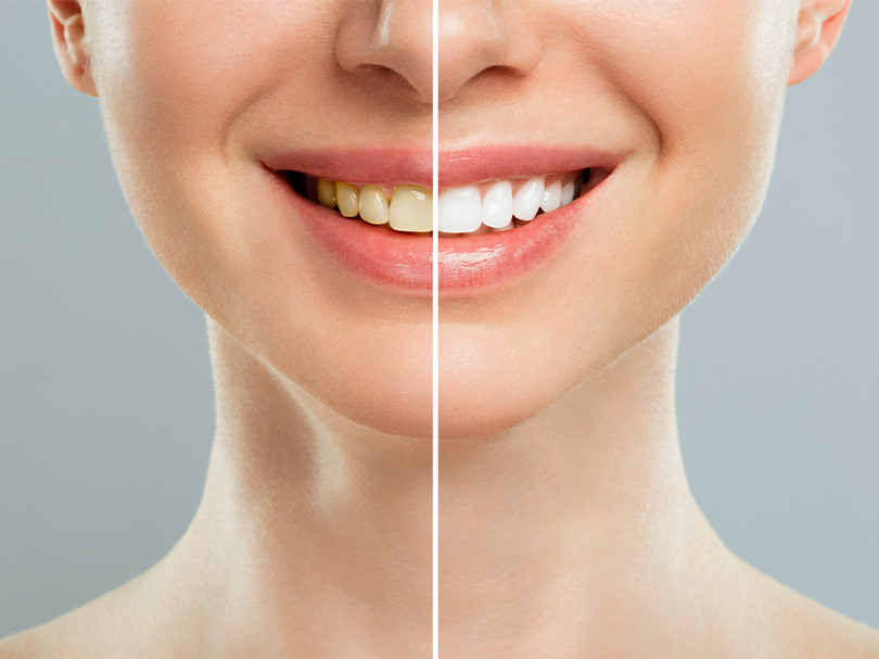 teeth whitening treatment in Thane