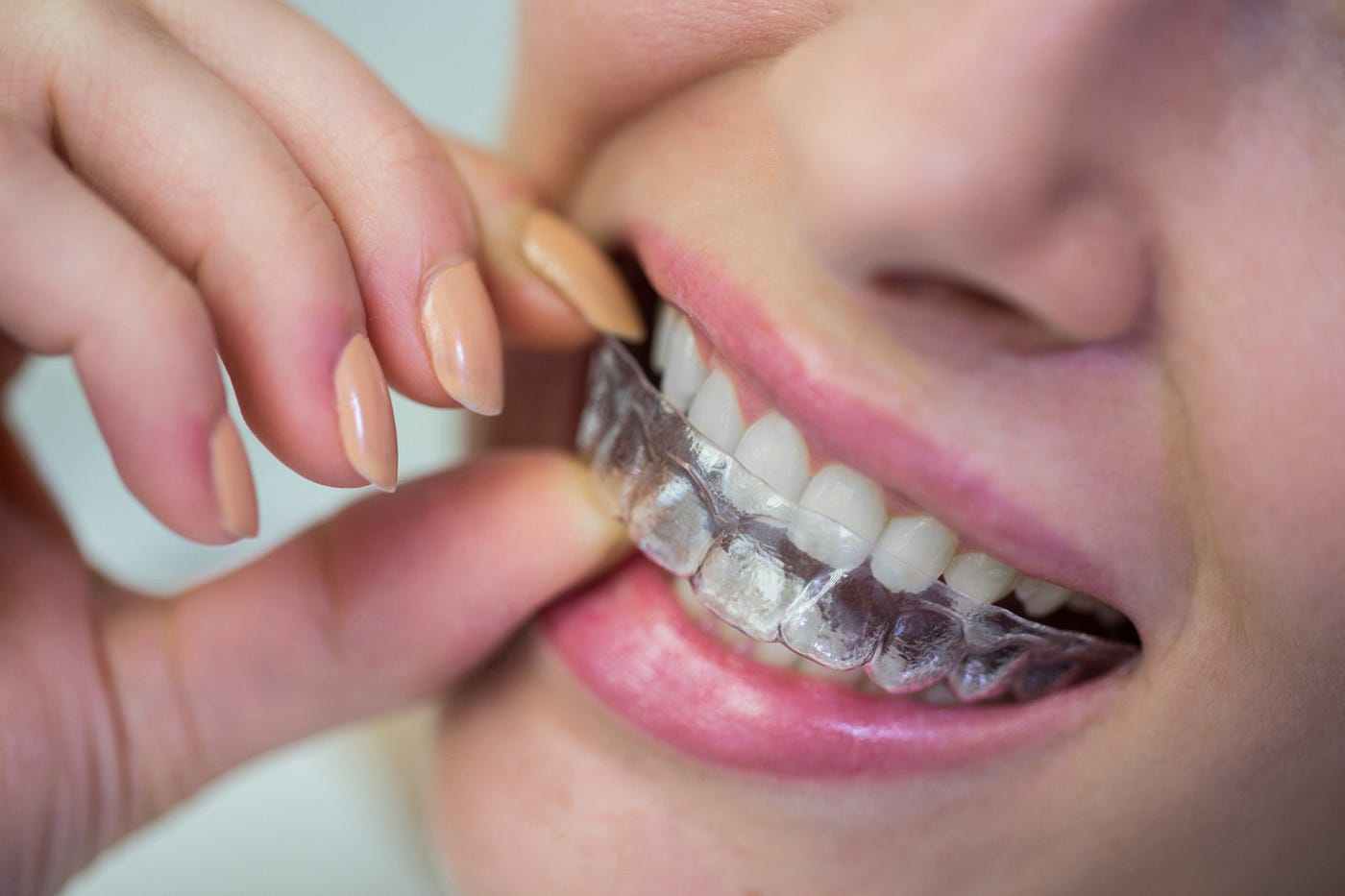 Dental braces treatment in Thane