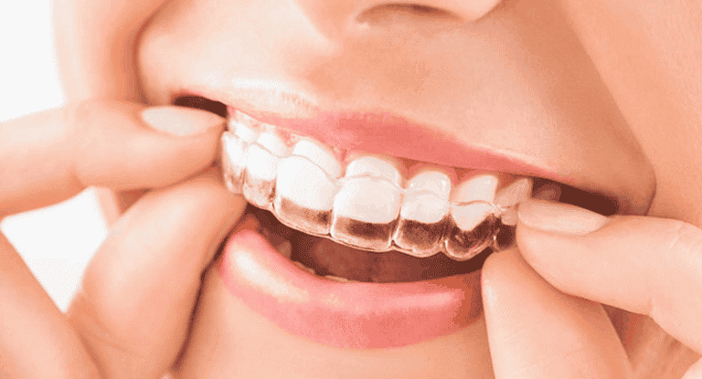 invisalign treatment clinic in Thane