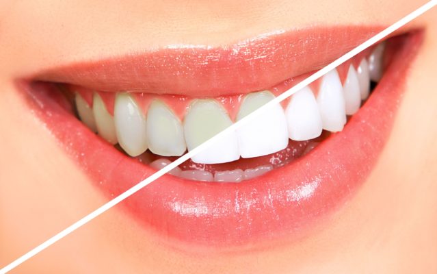 teeth whitening treatment in Thane