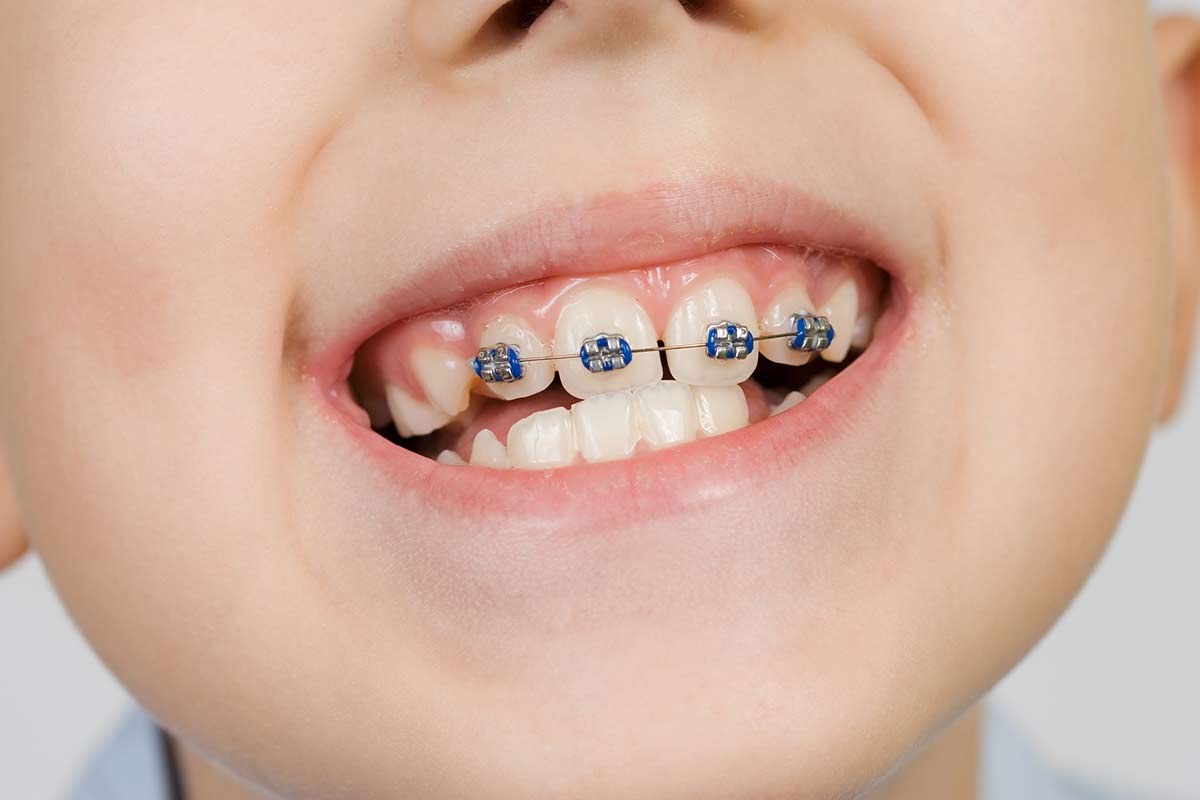 dental braces treatment for kids