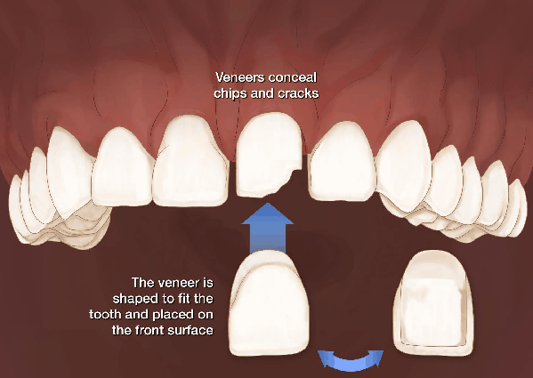 dental veneers treatment in Thane